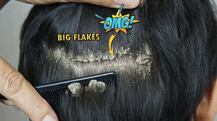 Combing And Scratching Dandruff Off Scalp #1174