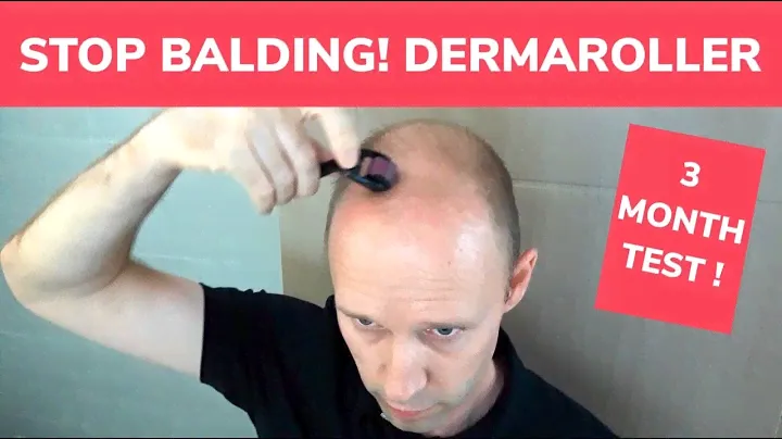STOP BALDING! - Dermaroller 3 Month Test and Tutorial