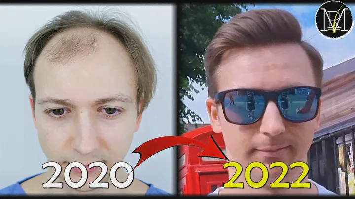 How I Regained my Hair!
